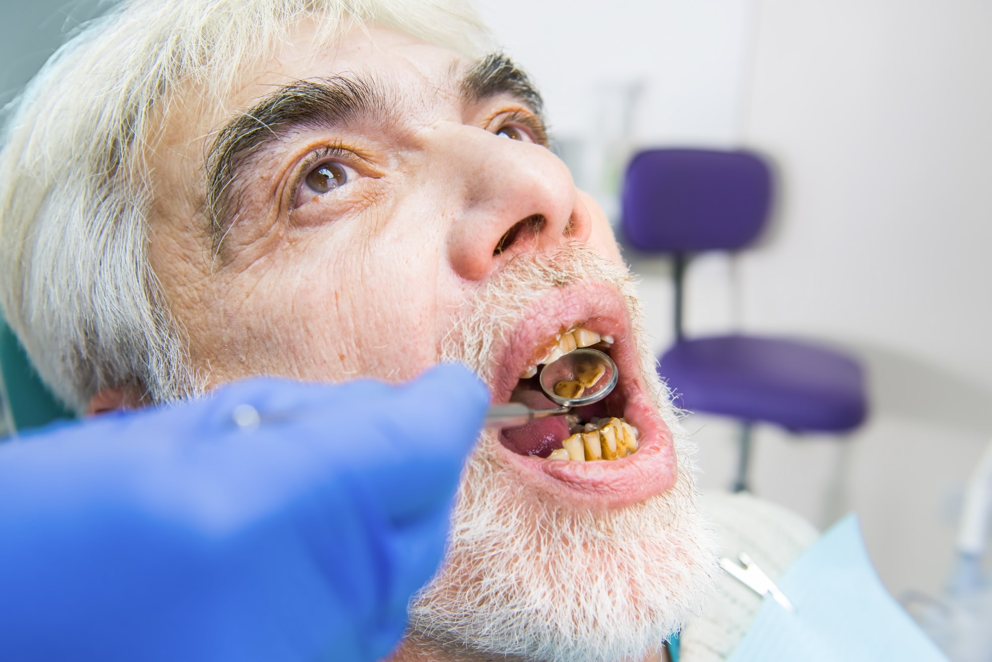 Elderly man with bad teeth