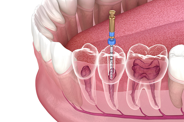 Root Canals